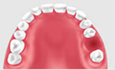 不大的牙齒齲洞裡面爛瞭一半是做補牙還是戴假牙呢-